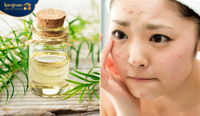 Dầu tràm trà khắc tinh của các loại mụn