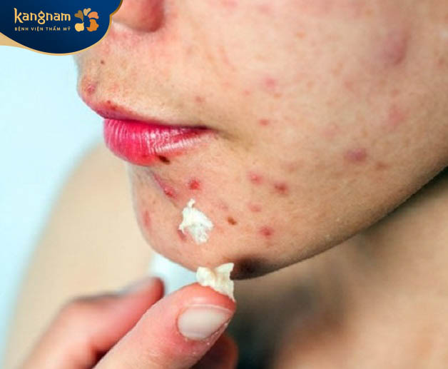 Da bị mụn và sẹo rỗ cần thoa kem lót trước khi trang điểm