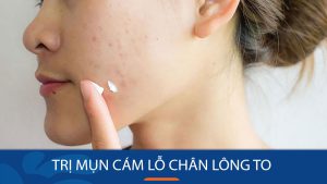 Bí quyết đánh bay mụn cám, se khít lỗ chân lông, lấy lại làn da sáng mịn chỉ trong 7 ngày
