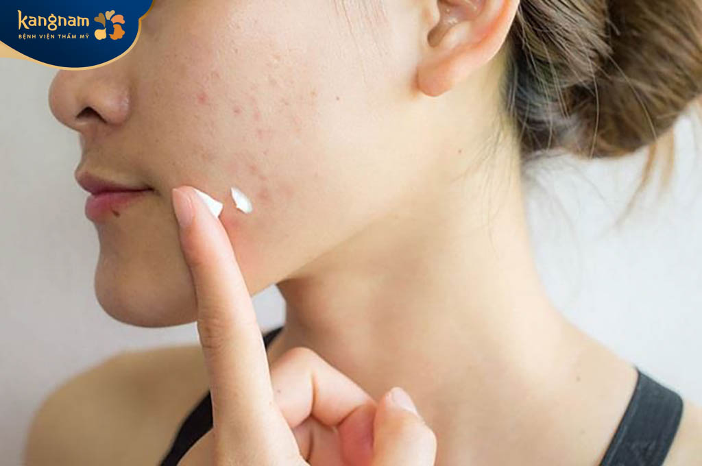 Sử dụng kem trị mụn dành cho da dầu cũng là cách trị mụn cám lỗ chân lông to hiệu quả