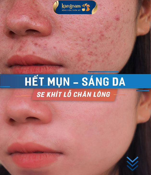 Hết mụn thêm xinh, tự tin và yêu đời