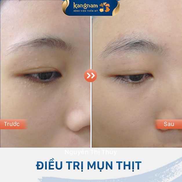 Trị mụn thịt tận gốc
