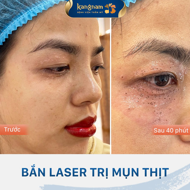 Xóa số mụn triệt để, không lo tái phát