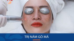 Bí quyết Đánh Bay Nám Gò Má Vĩnh Viễn Chỉ Trong 7 Ngày