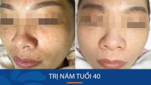Trị nám tuổi 40 khó hay dễ? Phương pháp điều trị nám tuổi 40