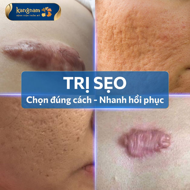 Trị sẹo bằng Laser Co2 tại Kangnam