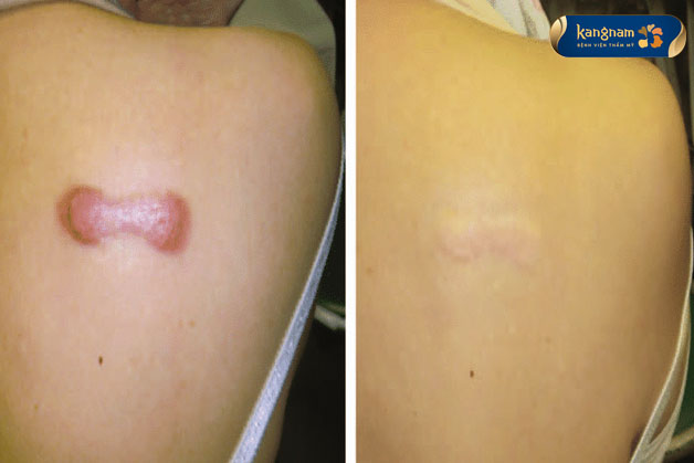 Khách hàng trị sẹo lồi tại Kangnam hiệu quả chỉ sau 1 liệu trình