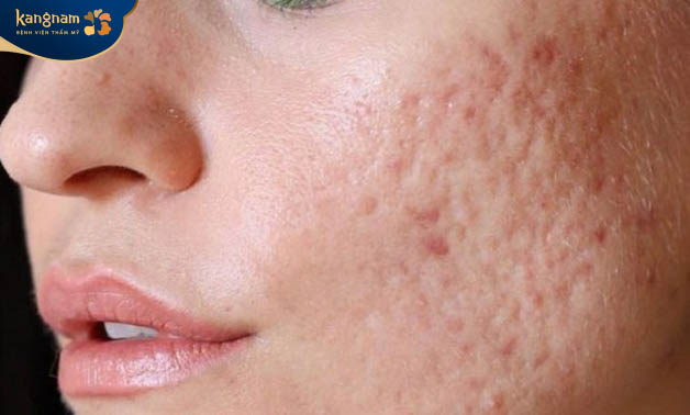 Trị sẹo rỗ 1 lần không thể hết được chân sẹo