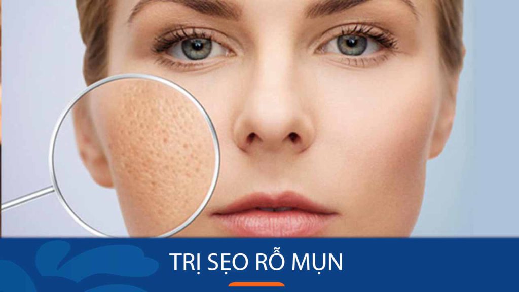 Bí quyết loại bỏ sẹo rỗ mụn tận gốc, trả lại làn da mịn màng