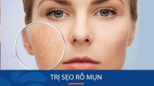 Bí quyết loại bỏ sẹo rỗ mụn tận gốc, trả lại làn da mịn màng