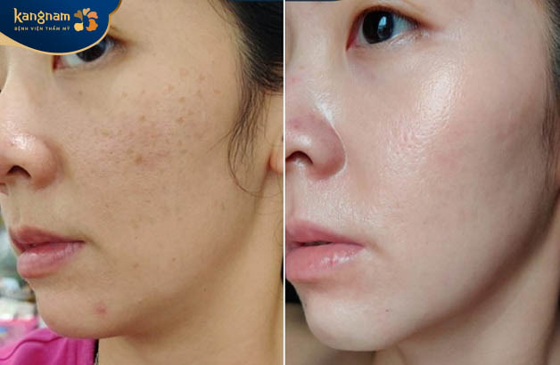 Da sáng, điều màu sau trị tàn nhang tại Kangnam