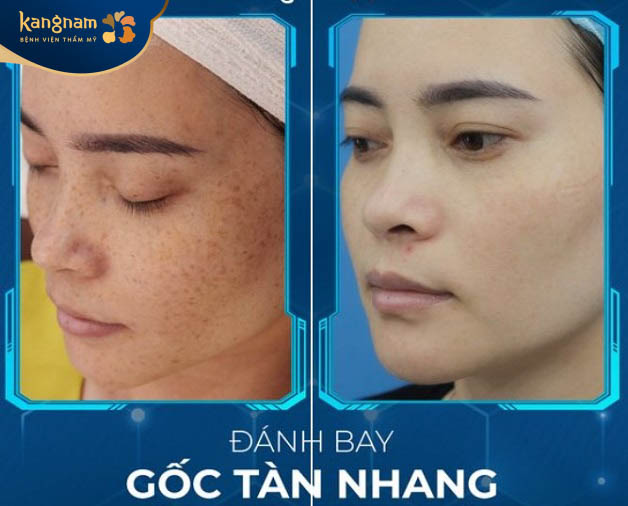 Đánh bay gốc tàn nhang với một liệu trình điều trị ứng dụng công nghệ Laser picosure