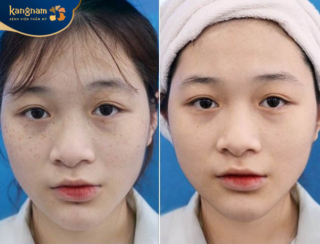 Viện thẩm mỹ Kangnam Hải Phòng địa chỉ trị tàn nhang uy tín