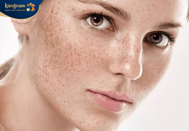 Trị 1 lần không loại bỏ tận gốc tàn nhang 