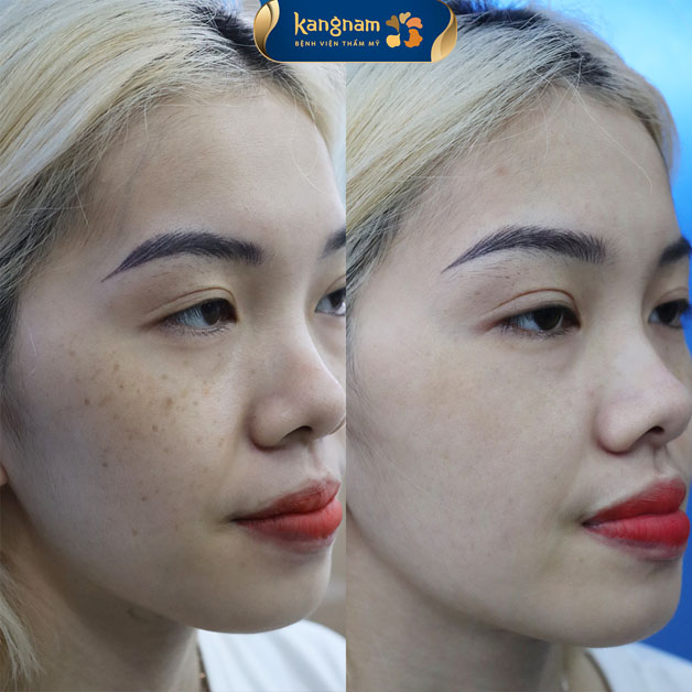 Bạn Nhã Đan đã loại bỏ được tàn nhang, làn da trắng sáng, mịn màng sau khi điều trị tại Kangnam