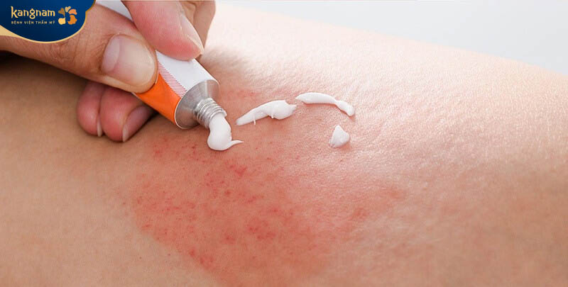 Thực tế triệt lông bị ngứa không nguy hiểm