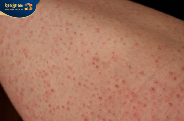 Đau rát, mẩn đỏ ở lỗ chân lông