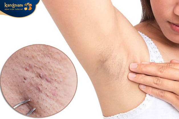 Mụn mủ hình thành ở các lỗ chân lông sau triệt lông