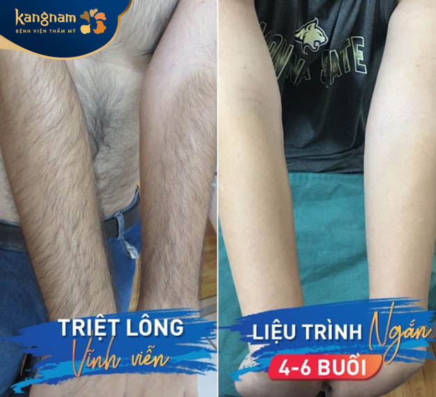 công nghệ triệt lông Diode Laser tân tiến
