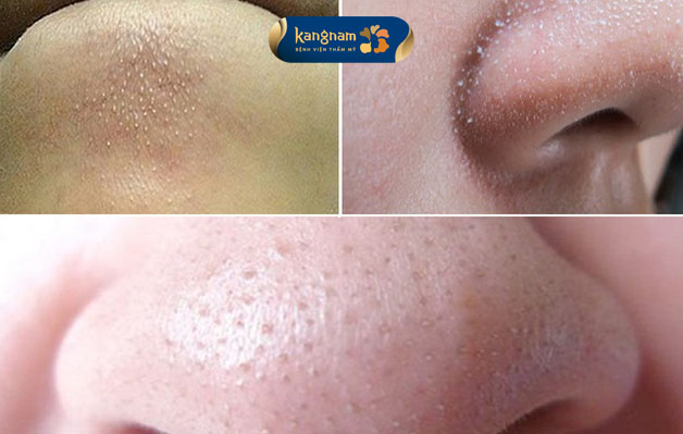 Mụn cám xuất hiện nhiều ở cằm, mũi, cánh mũi