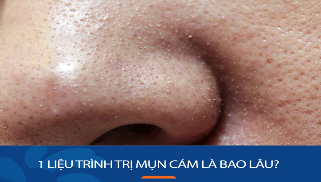 1 Liệu trình trị mụn cám là bao lâu? Bí Quyết Rút Ngắn Thời Gian