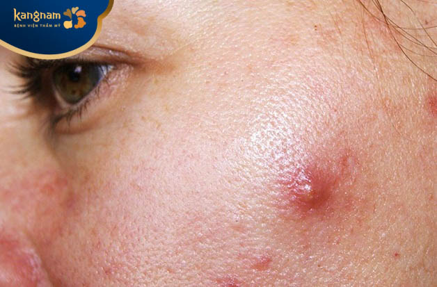 Mụn nang mức độ nhẹ 