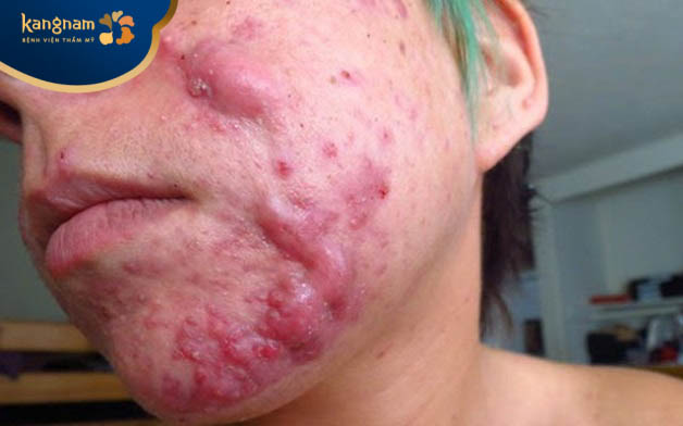 Mụn nang mức độ nghiêm trọng