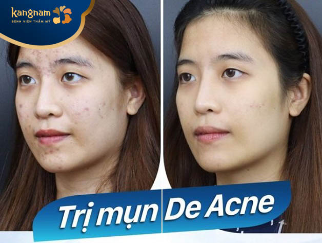điều trị mụn nang theo công nghệ De-Acne