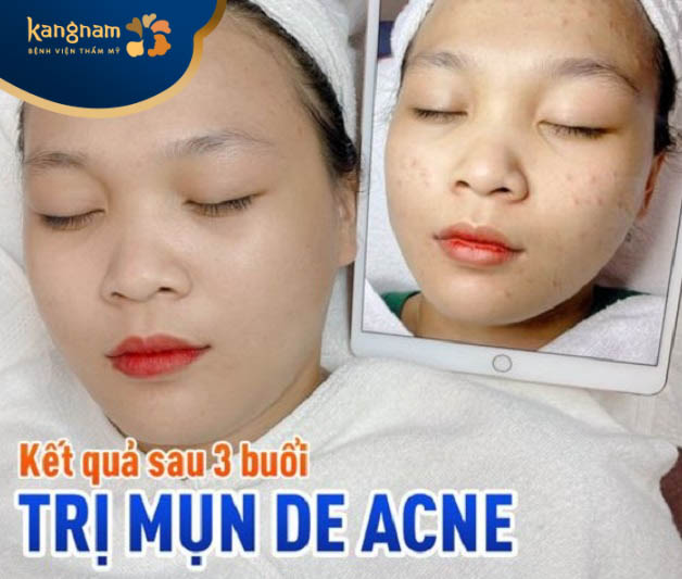 Khách hàng Lê Trang (18 tuổi) phản hồi sau 1 buổi đi soi da, nhận tư vấn miễn phí và trị mụn tại Kangnam