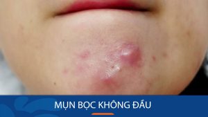 Mụn Bọc Không Đầu – Loại Bỏ Dứt Điểm Chỉ Trong 7 Ngày