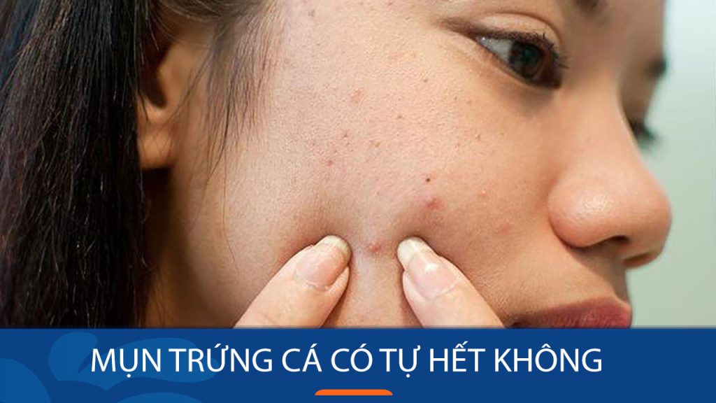 Mụn trứng cá có tự hết không? Cần lưu ý điều gì