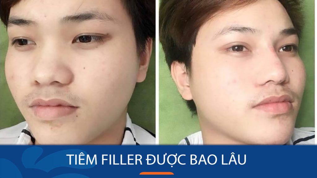 Tiêm filler được bao lâu? Cách chăm sóc để được lâu dài
