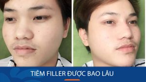 Tiêm filler được bao lâu? Cách chăm sóc để được lâu dài