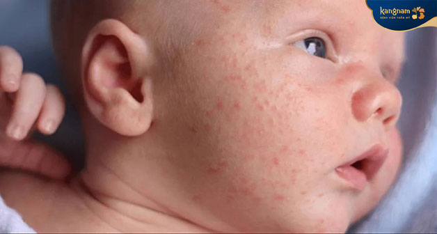 Mụn thịt mạch máu thường xuất hiện ở trẻ sơ sinh 