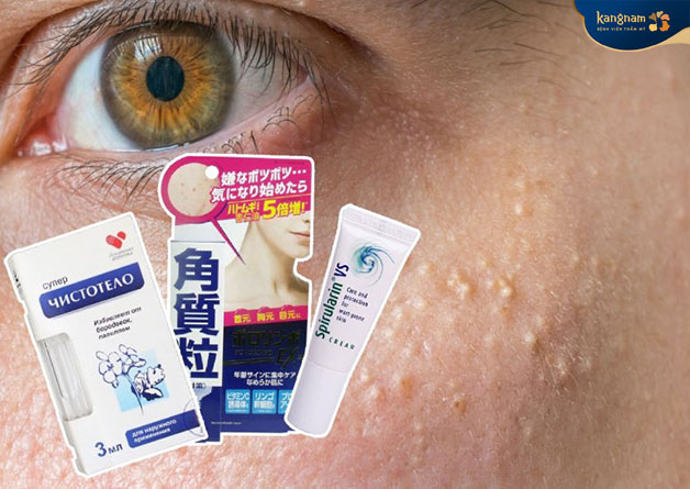 Mụn thịt không tự tiêu biến mà phải dùng thuốc hoặc phương pháp chuyên sâu