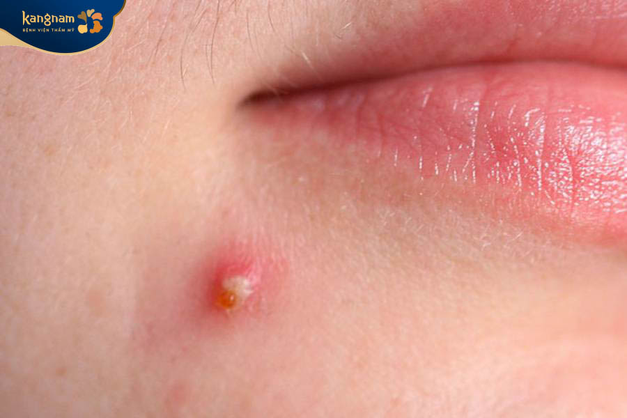 Mụn bọc kèm theo dịch