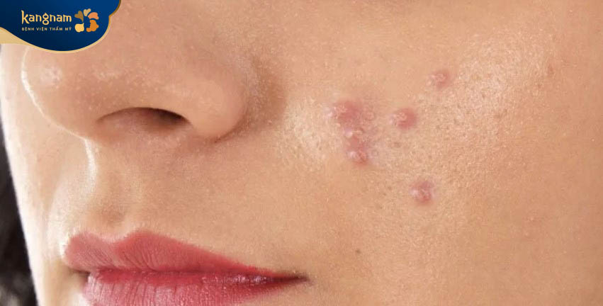 Mụn bọc bị chai cứng