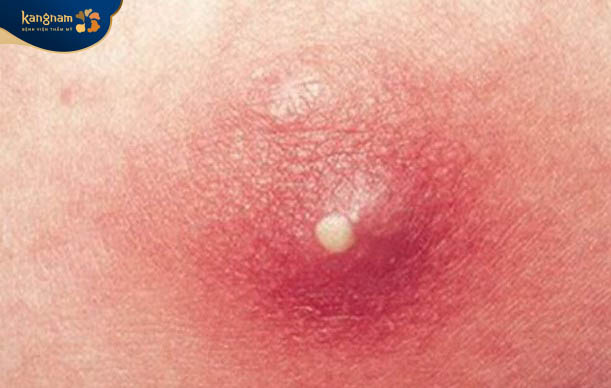 Cách quan sát mụn bọc đã chín