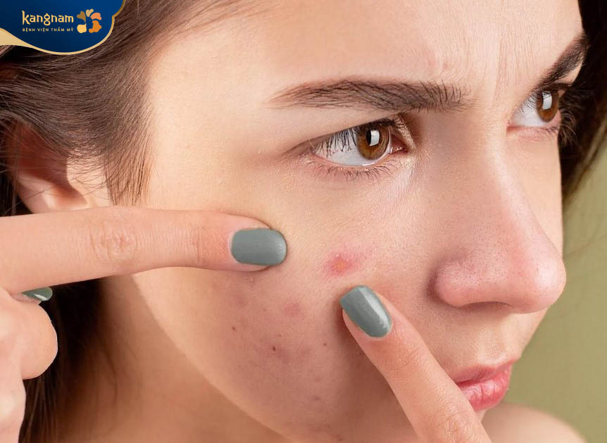 Mụn bọc không nặn không tự hết được