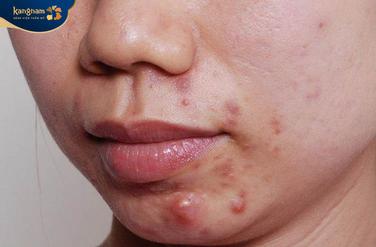 Những lưu ý khi điều trị mụn bọc