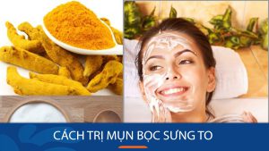 Cách trị mụn bọc sưng to tận gốc tại nhà – Bí quyết [Thời gian] [Hiệu quả]