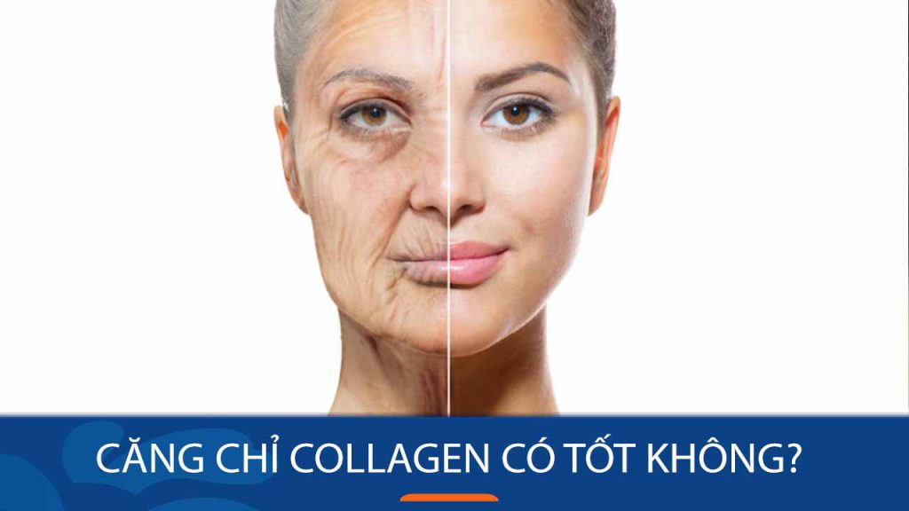 Căng chỉ collagen có tốt không? Giải đáp từ tiến sĩ chuyên khoa RICHARD HUY