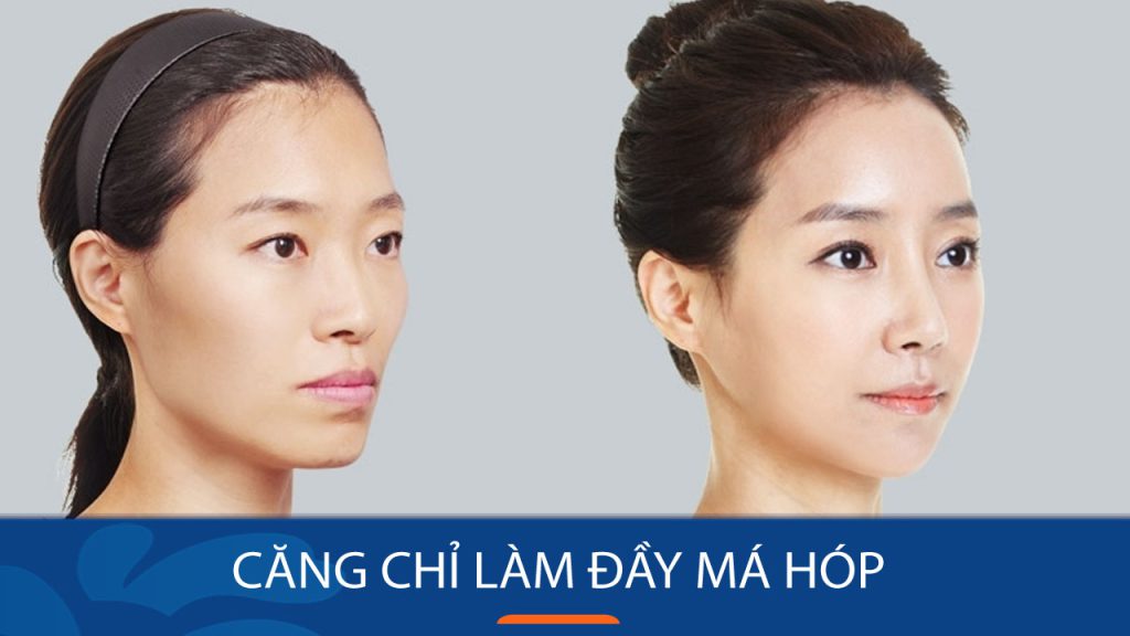 Căng chỉ làm đầy má hóp: Bí quyết trẻ hóa da mặt hiệu quả