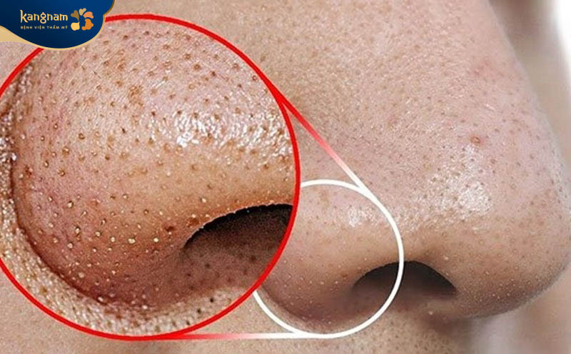 Nếu không chăm sóc mặt cẩn thận mụn đầu đen dễ phát triển thành mụn viêm