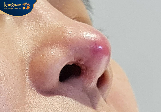 Tình trạng sưng đỏ sẽ xảy ra khi tiêm chất làm đầy trong ngày "đèn đỏ"