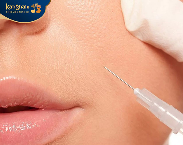 "Có nên tiêm filler rãnh cười không?" rất được phụ nữ tuổi trung niên quan tâm 