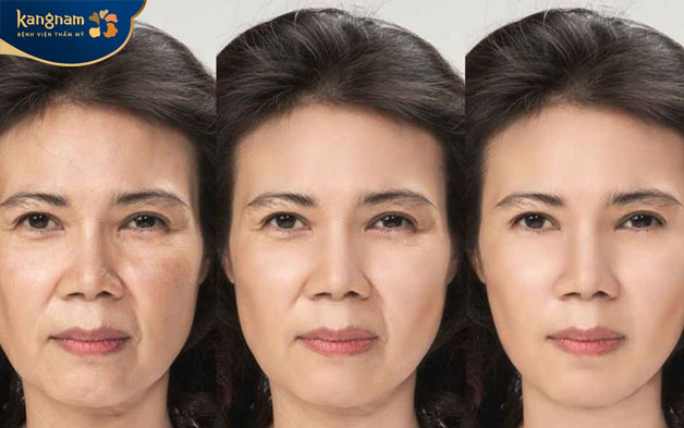 Sau 1 năm, rãnh cười dần trở về hình dáng lúc đầu