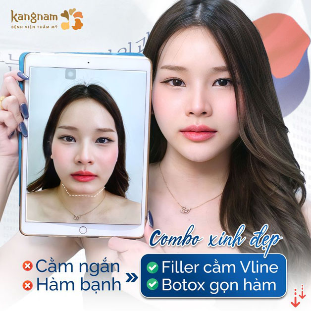 Tiêm boton gọn hàm đẹp tự nhiên, không đau đớn