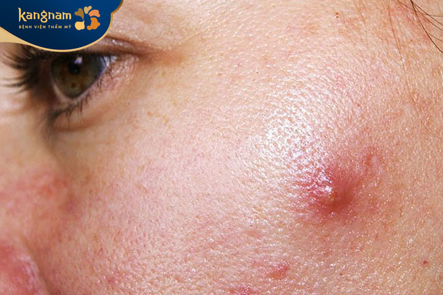 Các giai đoạn của mụn viêm