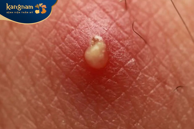 Mụn chứa nhiều mủ bên trong